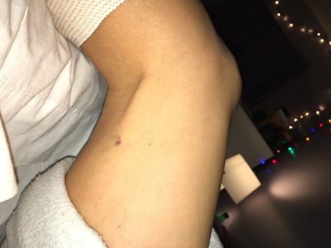 Shots were given to Sophia Arnao on her surgery date. The small bruise shown above, his where the needle was injected into her right thigh. This was taken two weeks after the shot was given to her. 